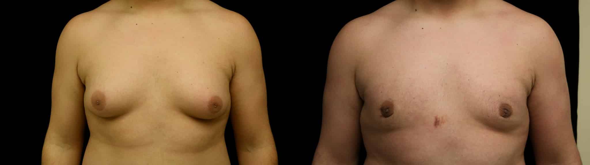 Gynecomastia Patient 5 Before & After