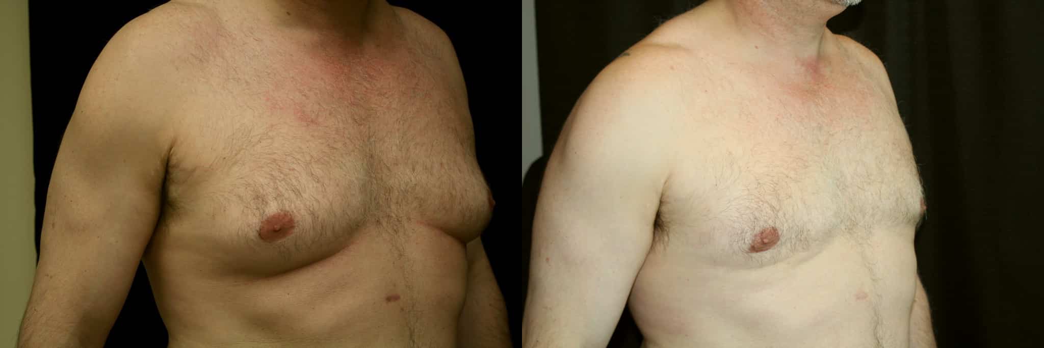 Gynecomastia Patient 19 Before & After Details