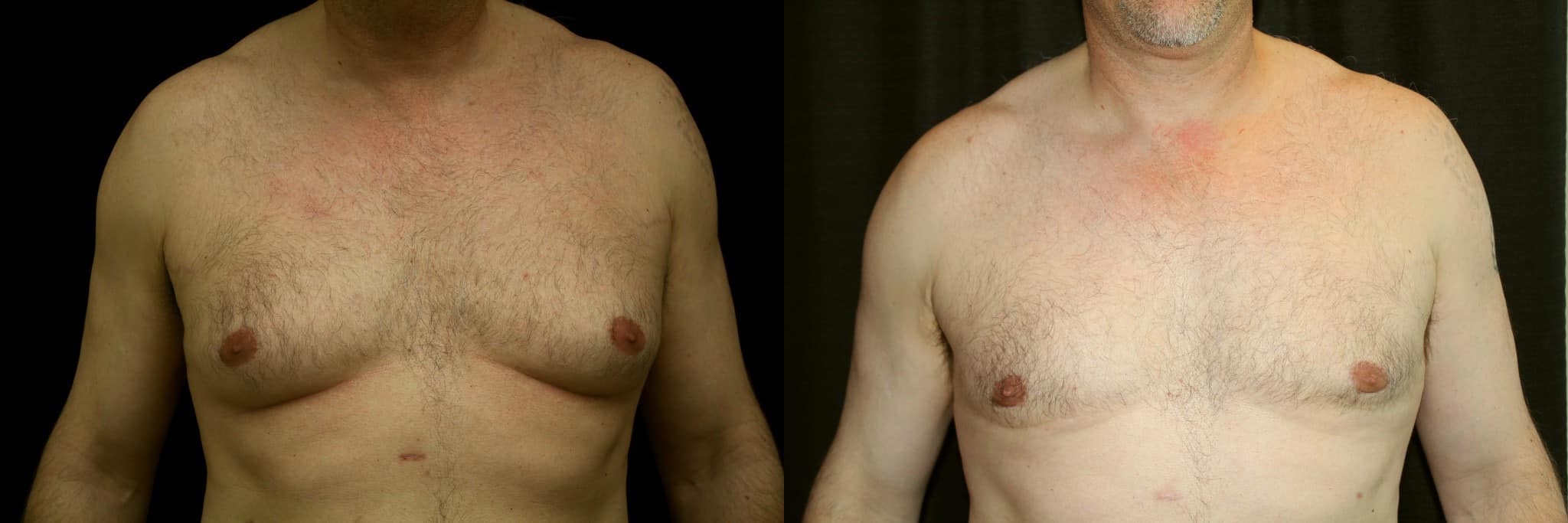 Gynecomastia Patient 19 Before & After