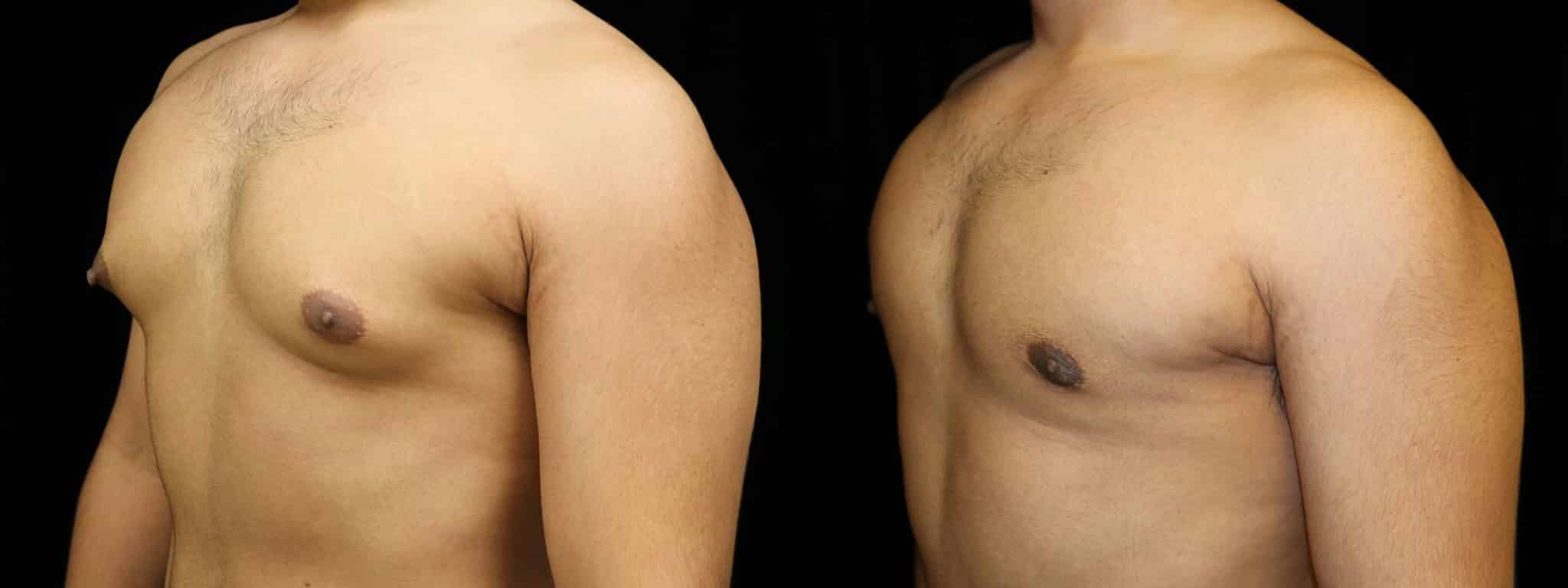 Gynecomastia Patient 15 Before & After Details