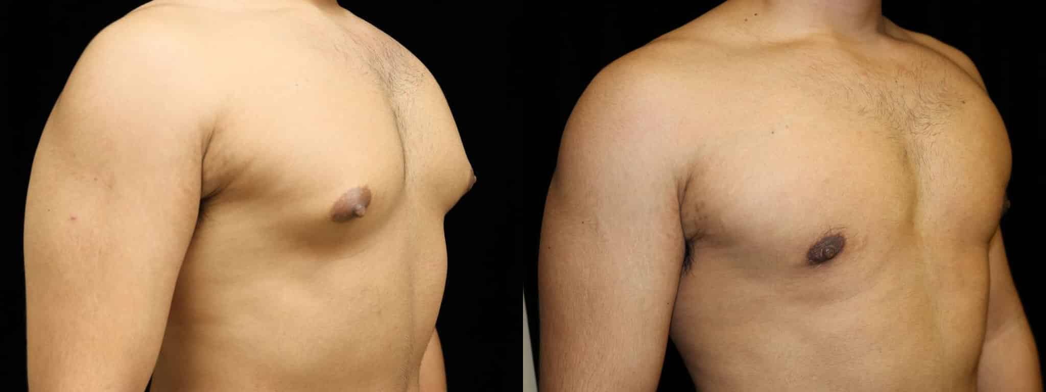 Gynecomastia Patient 15 Before & After Details