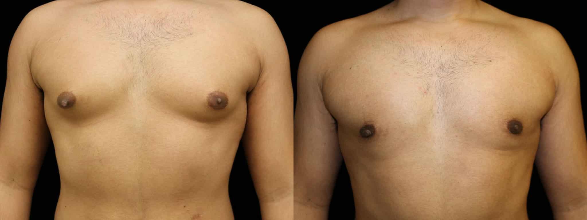 Gynecomastia Patient 15 Before & After