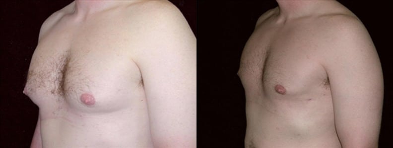 Gynecomastia Patient 18 Before & After