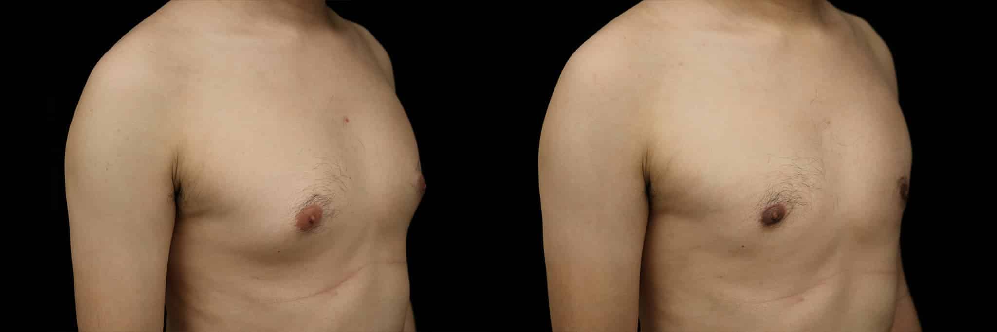 Gynecomastia Patient 17 Before & After Details