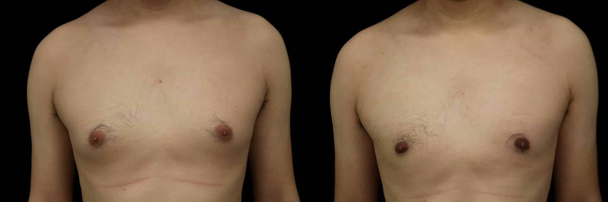 Gynecomastia Patient 17 Before & After