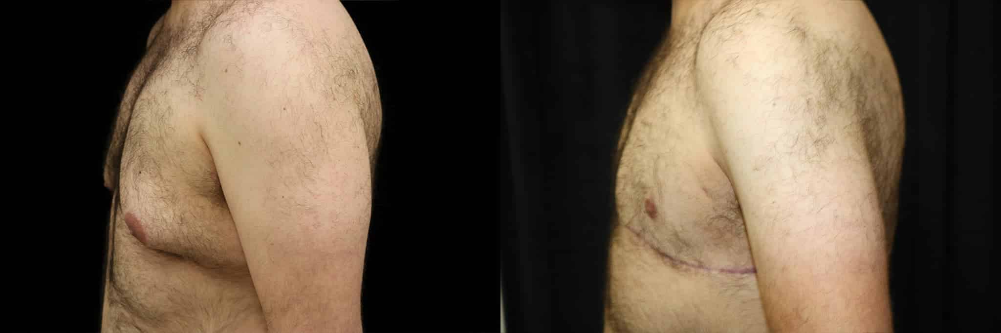 Gynecomastia Patient 3 Before & After Details