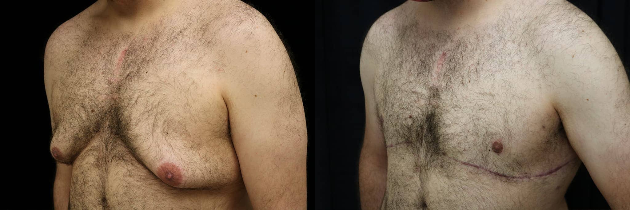 Gynecomastia Patient 3 Before & After Details