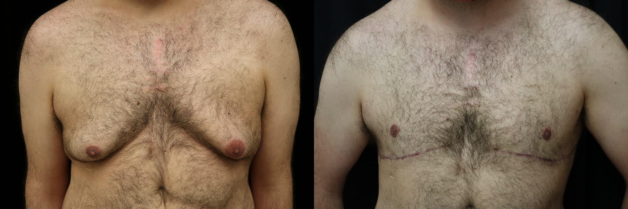 Gynecomastia Patient 3 Before & After