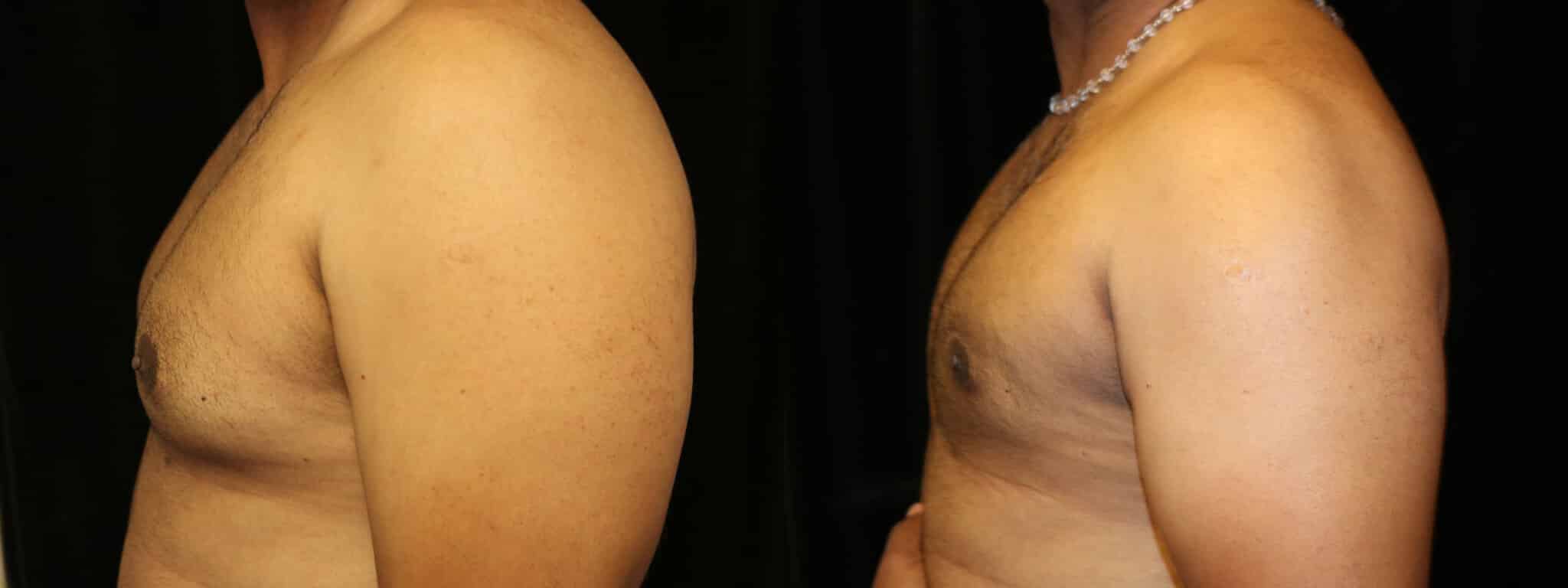 Gynecomastia Patient 19 Before & After Details