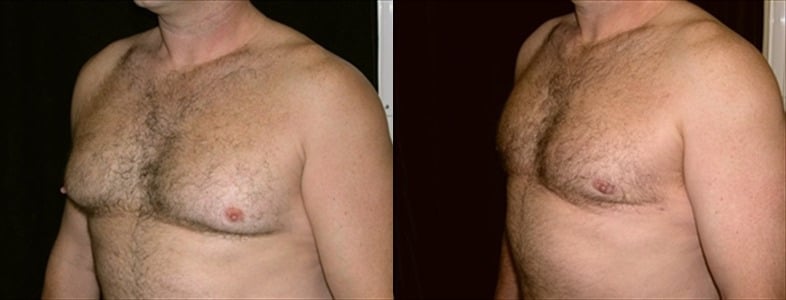 Gynecomastia Patient 21 Before & After