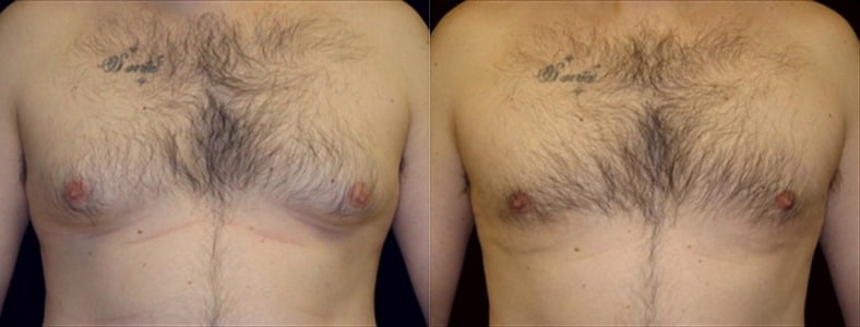 Gynecomastia Patient 2 Before & After