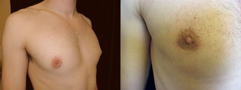 Gynecomastia Patient 9 Before & After