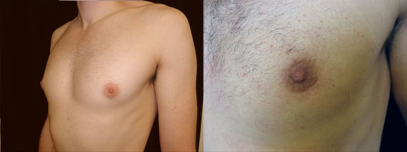 Gynecomastia Patient 9 Before & After Details