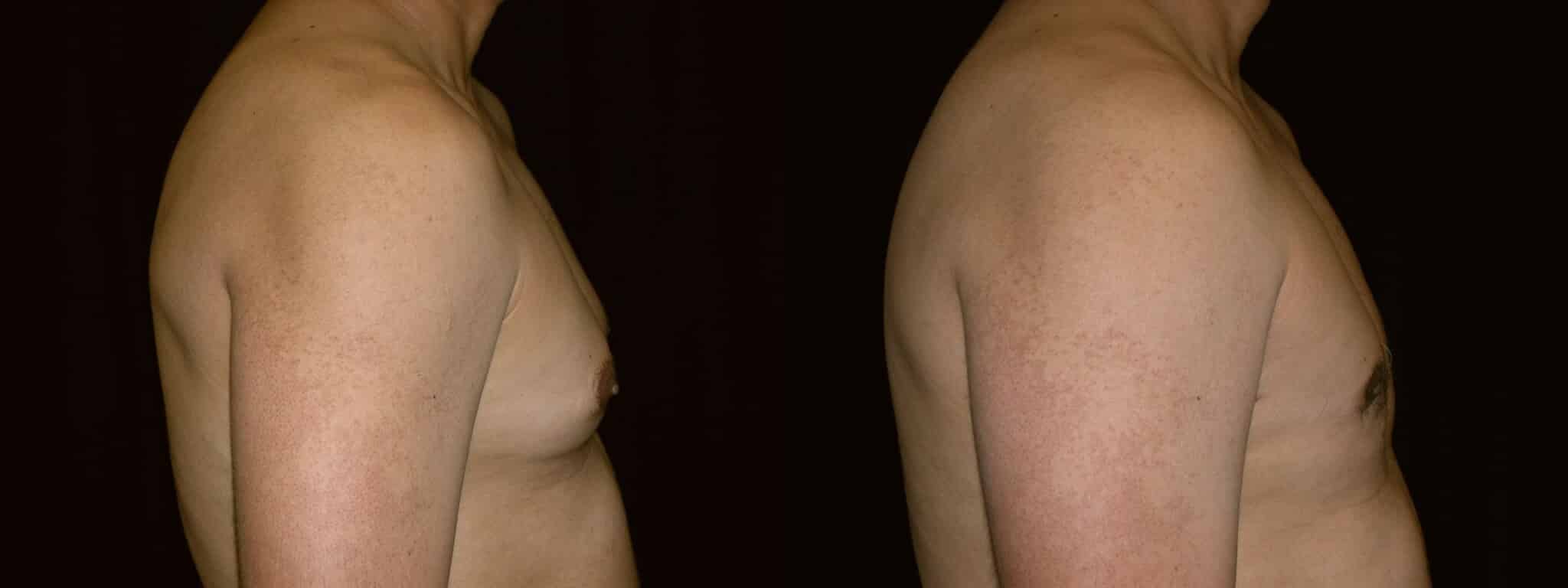 Gynecomastia Patient 9 Before & After Details