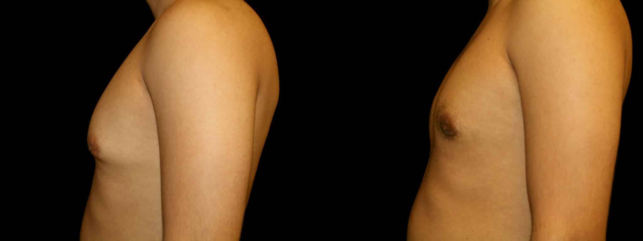 Gynecomastia Patient 20 Before & After Details