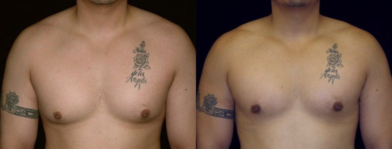 Gynecomastia Patient 21 Before & After