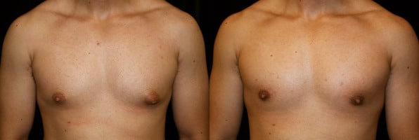 Gynecomastia Patient 13 Before & After