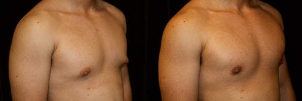 Gynecomastia Patient 13 Before & After Details