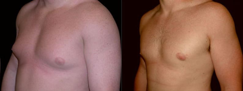 Gynecomastia Patient 3 Before & After Details