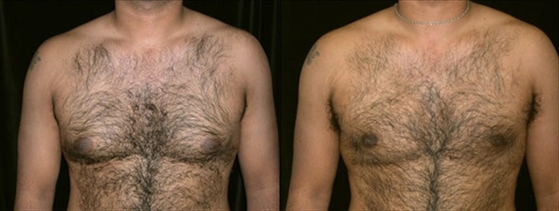 Gynecomastia Patient 15 Before & After