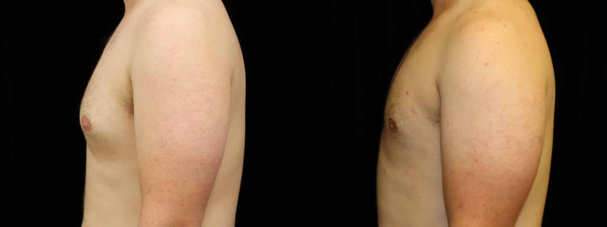 Gynecomastia Patient 16 Before & After Details