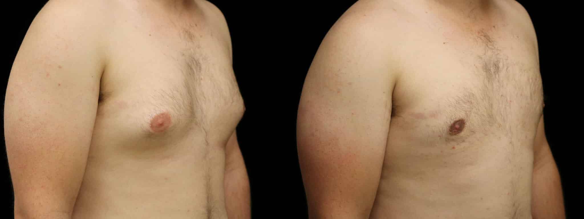 Gynecomastia Patient 16 Before & After Details