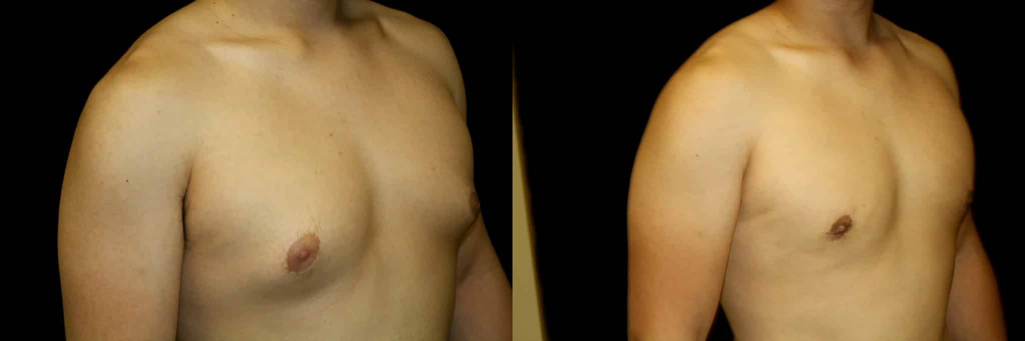 Gynecomastia Patient 6 Before & After Details