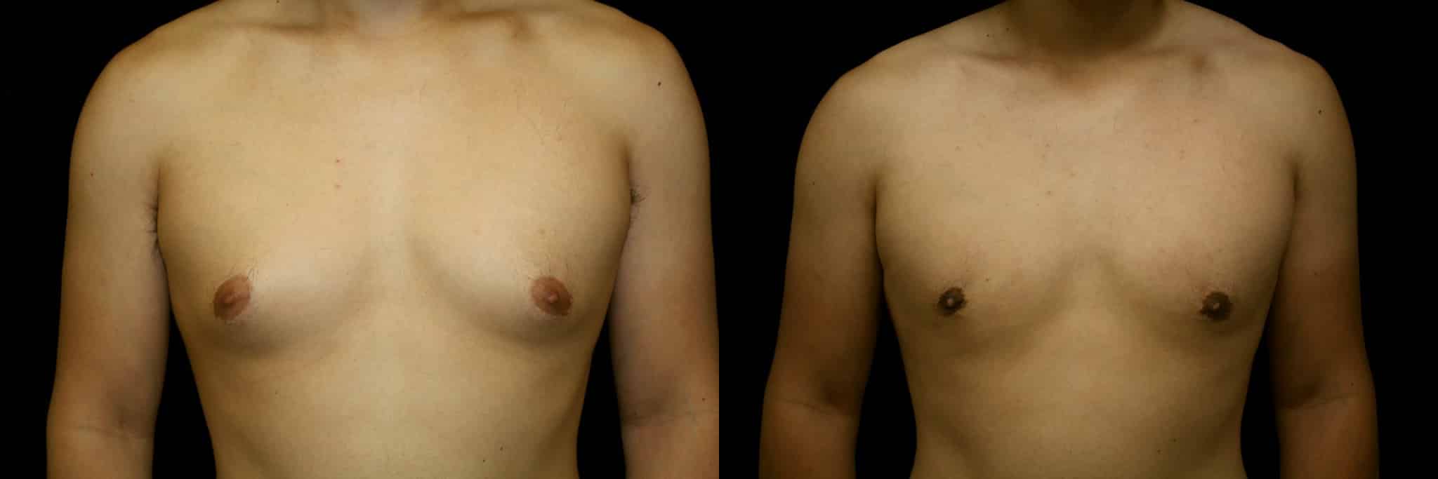 Gynecomastia Patient 6 Before & After