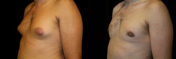 Gynecomastia Patient 8 Before & After Details