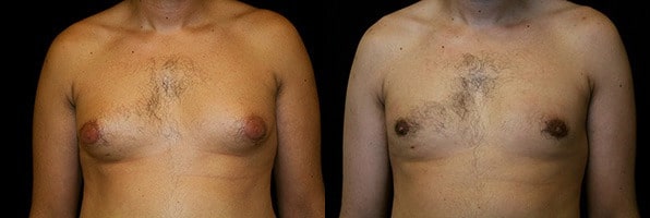 Gynecomastia Patient 8 Before & After