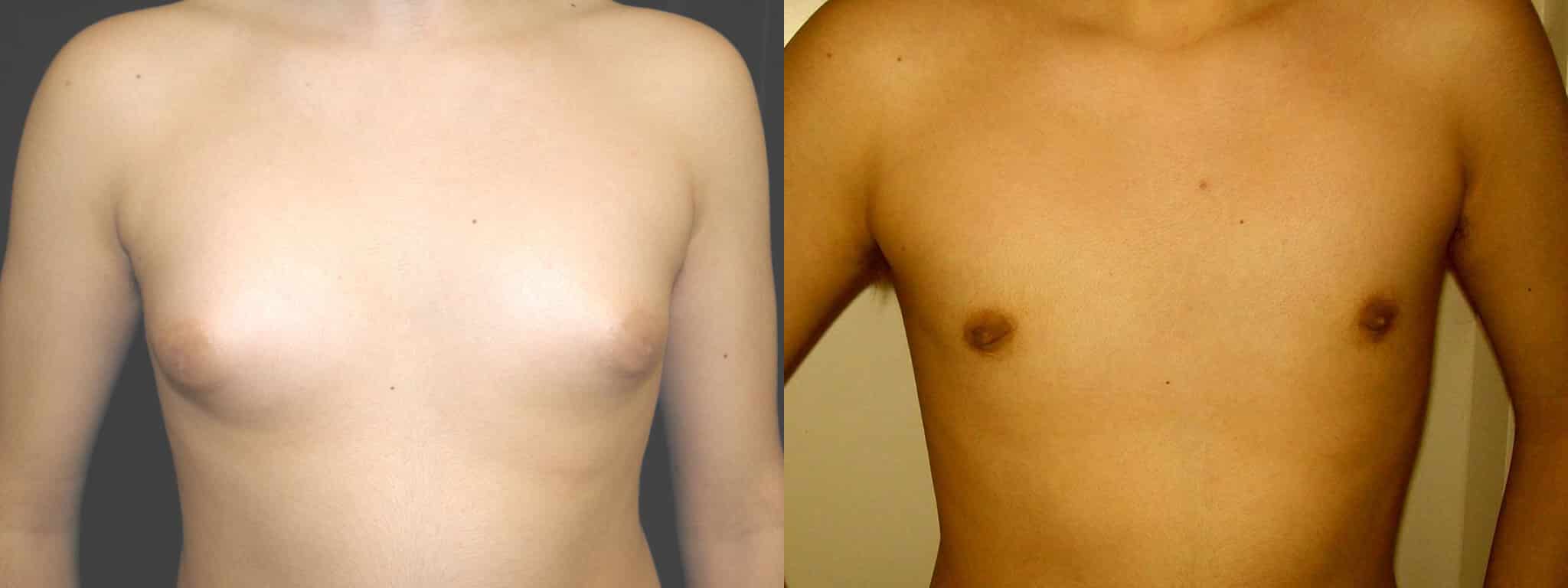 Gynecomastia Patient 14 Before & After