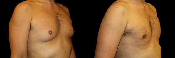 Gynecomastia Patient 10 Before & After Details