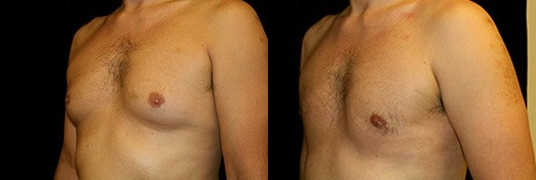 Gynecomastia Patient 10 Before & After Details