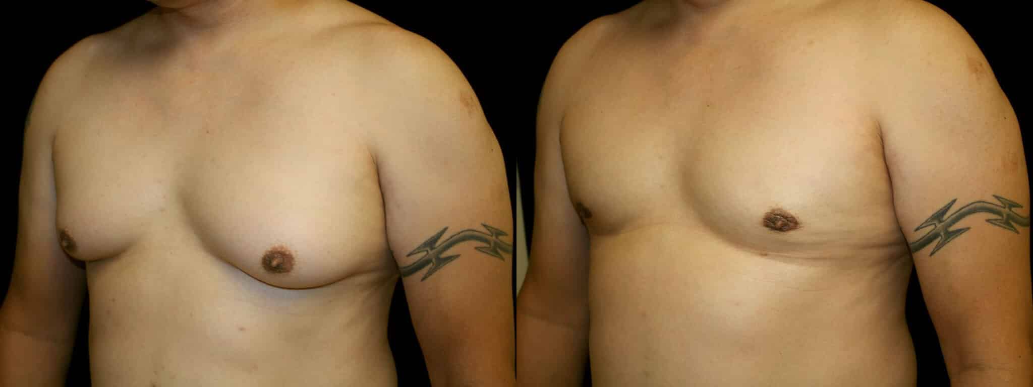 Gynecomastia Patient 6 Before & After Details