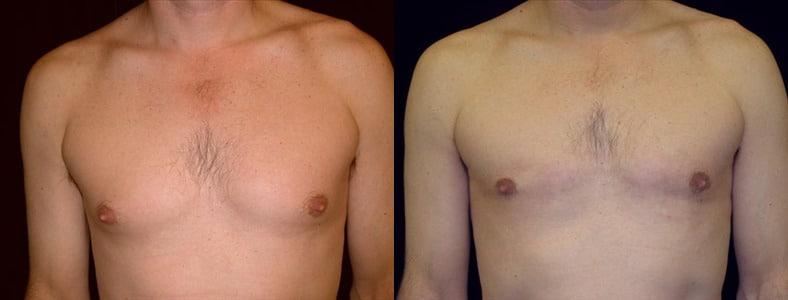 Gynecomastia Patient 18 Before & After