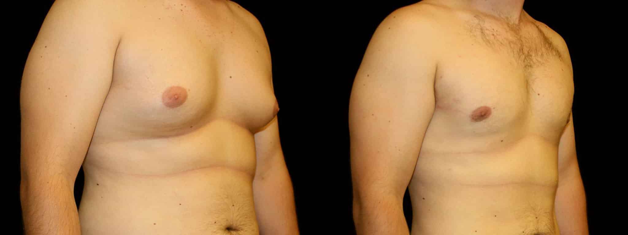 Gynecomastia Patient 3 Before & After Details