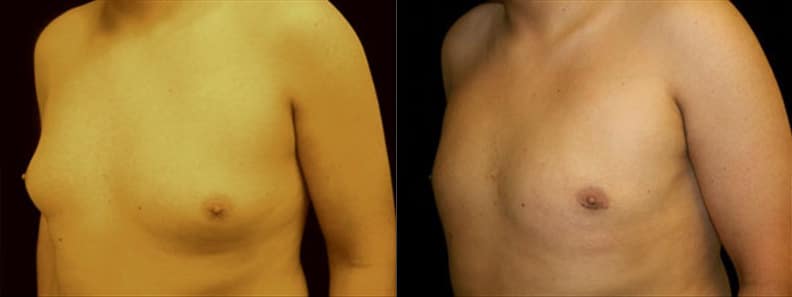 Gynecomastia Patient 7 Before & After Details