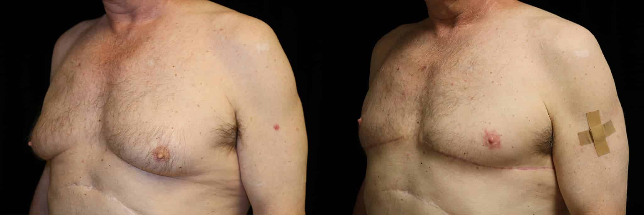 Gynecomastia Patient 14 Before & After Details