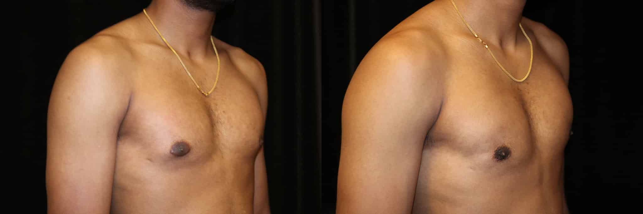Gynecomastia Patient 12 Before & After Details