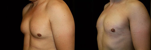 Gynecomastia Patient 7 Before & After Details