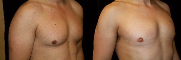 Gynecomastia Patient 7 Before & After Details