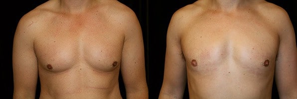 Gynecomastia Patient 7 Before & After