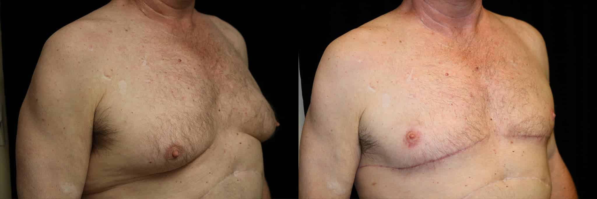 Gynecomastia Patient 14 Before & After Details