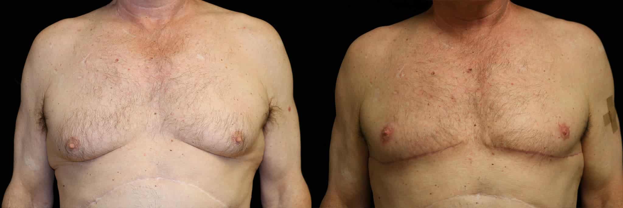 Gynecomastia Patient 14 Before & After