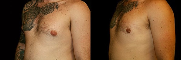 Gynecomastia Patient 1 Before & After Details