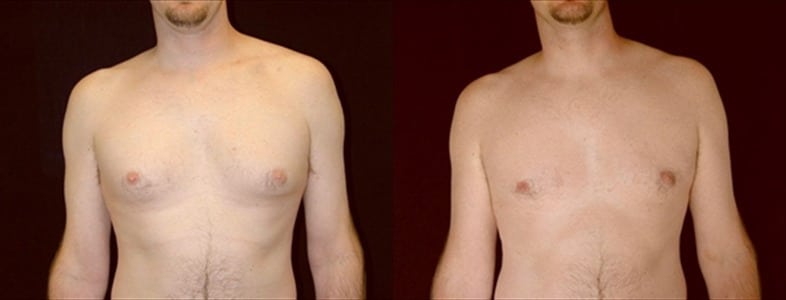 Gynecomastia Patient 19 Before & After