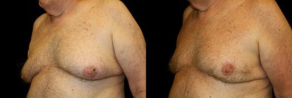 Gynecomastia Patient 19 Before & After Details