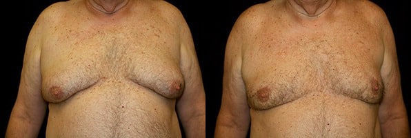 Gynecomastia Patient 19 Before & After