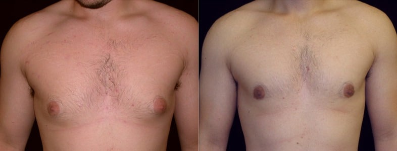 Gynecomastia Patient 8 Before & After