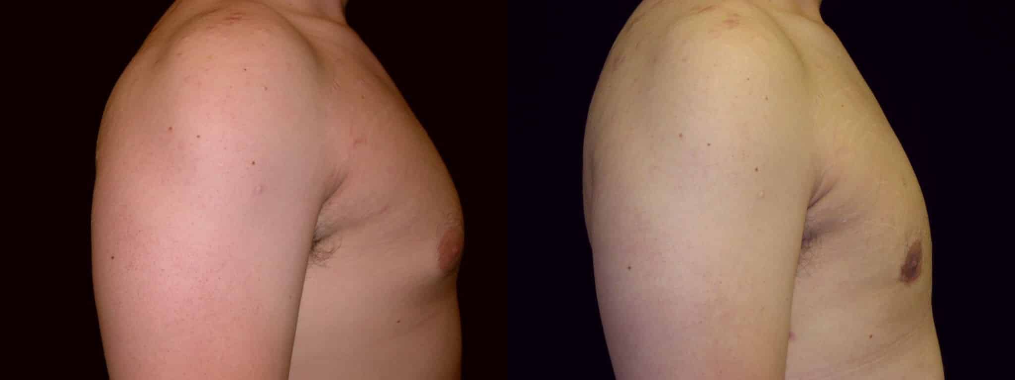 Gynecomastia Patient 13 Before & After Details